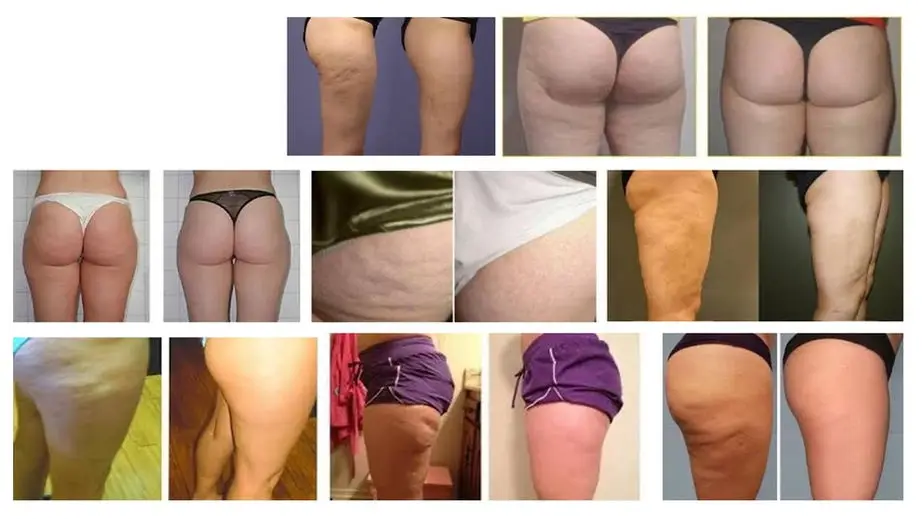 Cellulite Reduction Cellulite Reduction