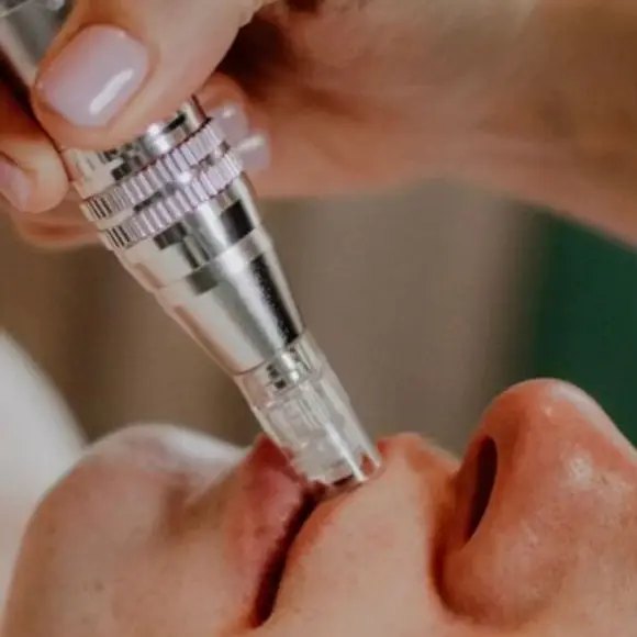 Close-up microneedling facial treatment for skin rejuvenation and collagen stimulation