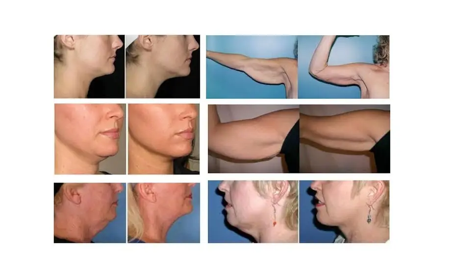 Skin Tightening Skin Tightening