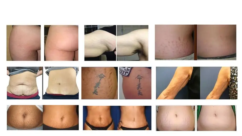Stretch-Mark Fading Stretch Mark Fading