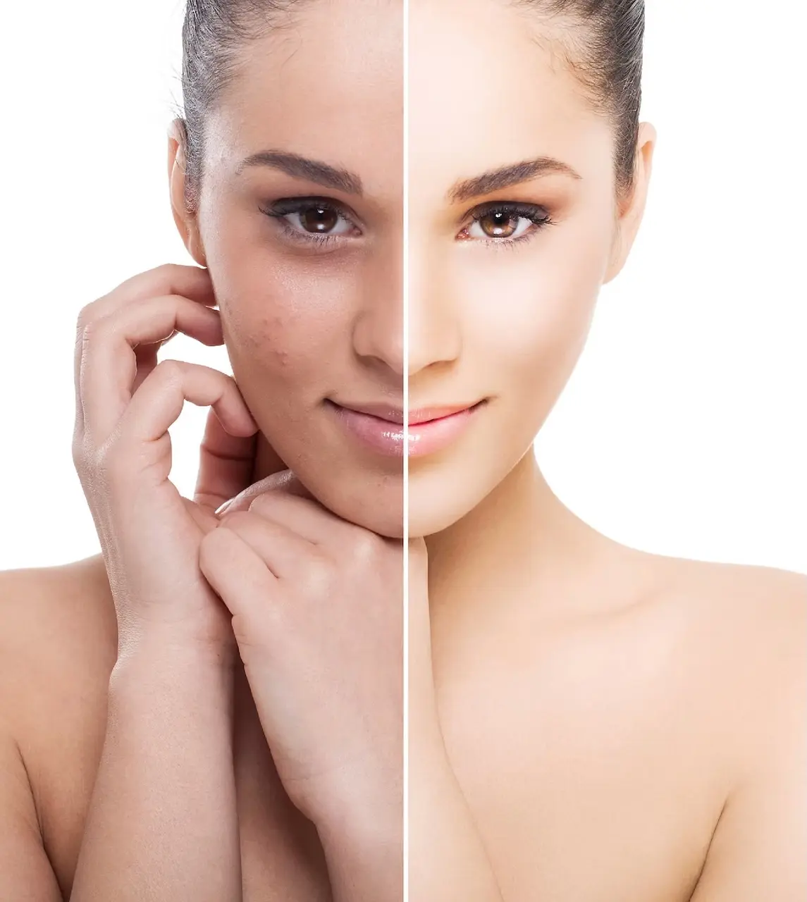Before and after acne treatment results with clearer glowing skin portrait